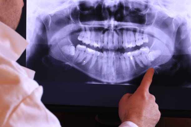 Best Emergency Tooth Extraction in Carencro, LA